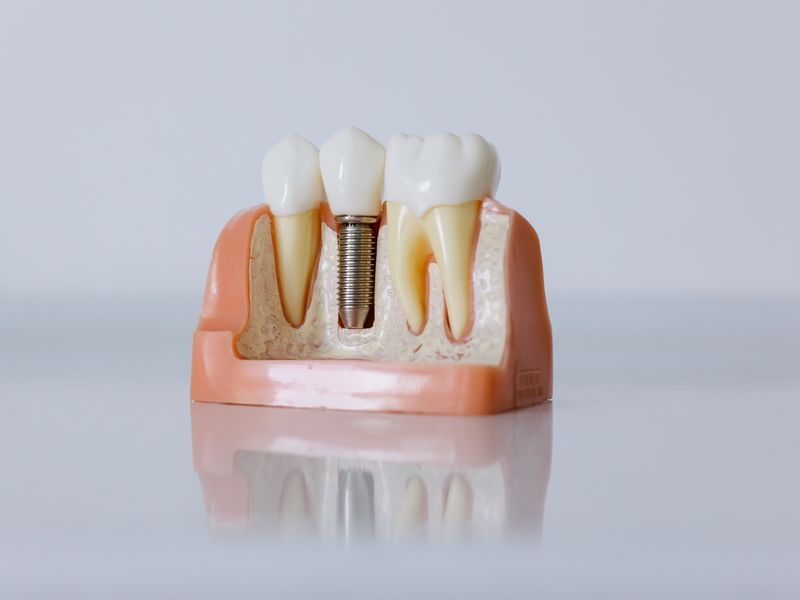 Implante dental